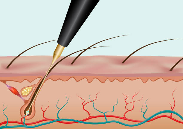 What is the Downside to Electrolysis?