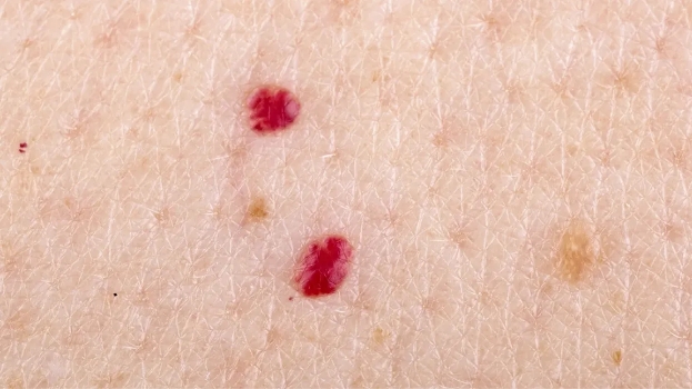 Bleeding After Waxing: Is It Normal?