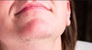 Can Foods Cause Facial Hair Growth in Females?