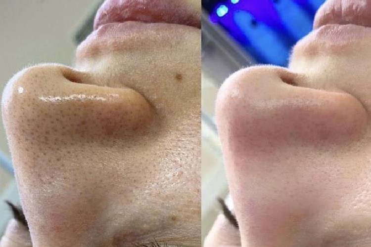 Deep Cleansing Facial Before and After