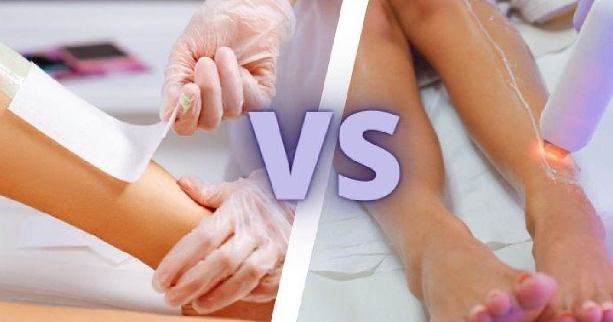 Laser Hair Removal vs Waxing