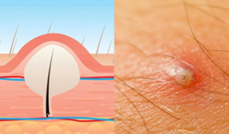 Risk of Ingrown Hair