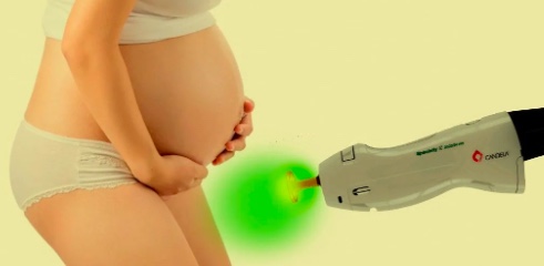 Why Should You Not Go for Laser Hair Removal in Pregnancy?