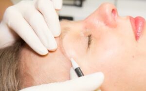 Facial Hair Removal: Electrolysis