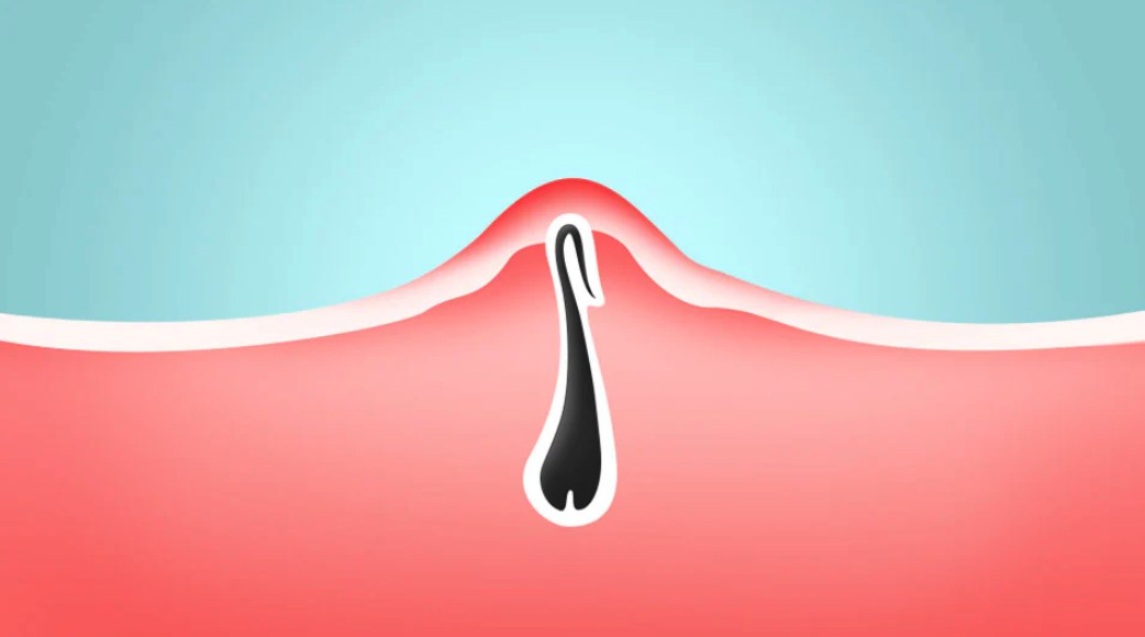 What Hair Removal Is Best for Ingrown Hair