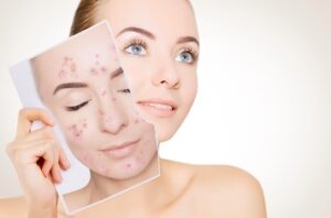 Does IPL Work for Acne?