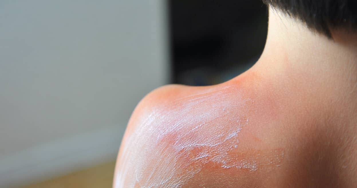 Does Sunburn Turn into Tan? (How to Turn) Ulike