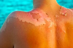 How to Turn a Sunburn into Tan?