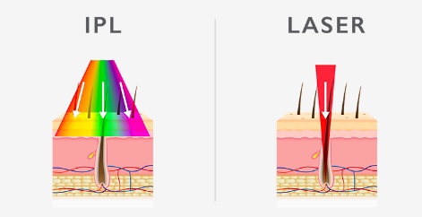 IPL Hair Removal Vs Laser Hair Removal