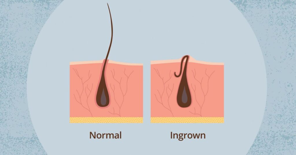 Ingrown Hair What It Looks Like Causes Treatment And Prevention Ulike