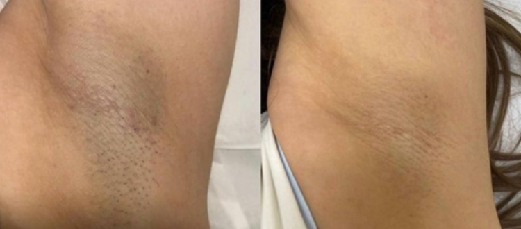 How Can I Get Ideal Hair Length For Laser Hair Removal Naturally