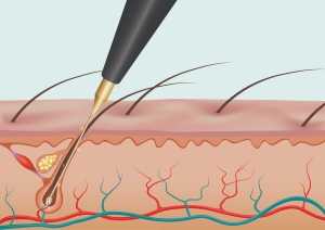 What is Electrolysis