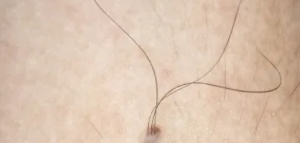 Why Do Two Hairs Grow In One Follicle