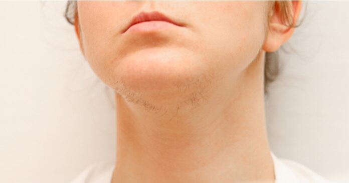 How Does Diet Affect Hirsutism (Excessive Hair)?