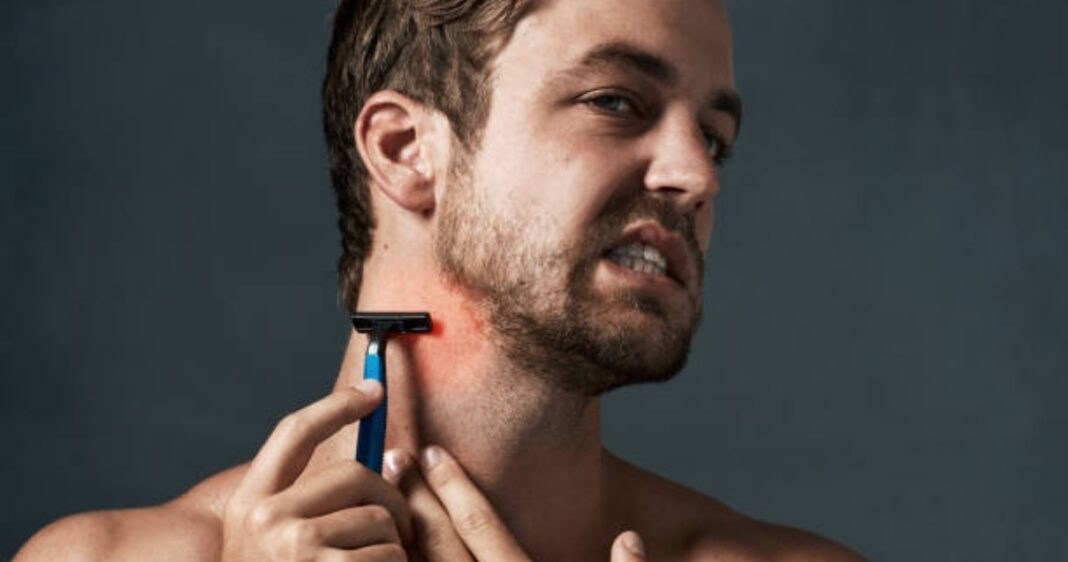 Top 3 Over-the-Counter Treatments for Razor Burns