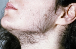 What Is the Cause of Hirsutism