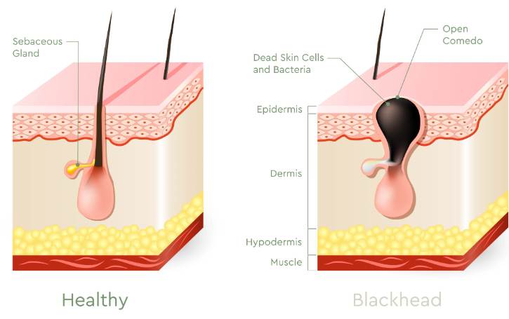 What are Blackheads