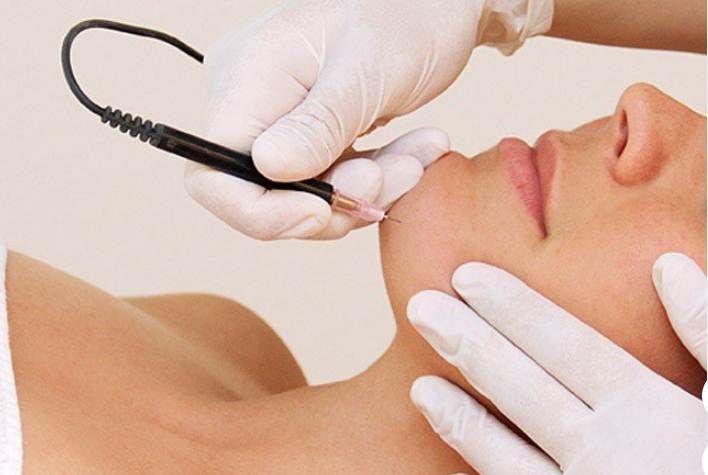 Electrolysis Permanent Hair Removal