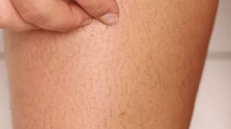 Pregnancy Reverse laser hair removal