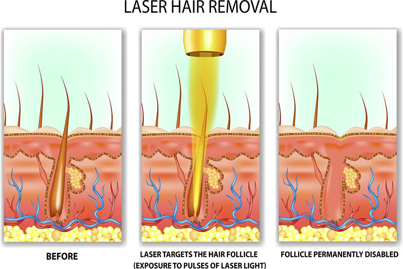 What’s Laser Hair Removal?