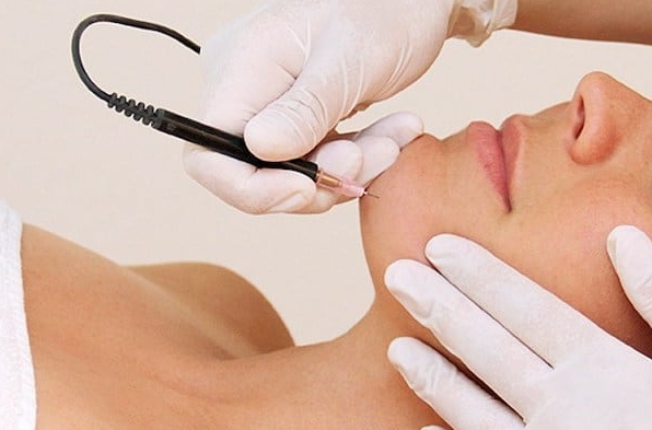 How is Electrolysis Hair Removal Done? 