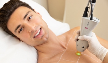 Is Candela Laser Hair Removal Permanent