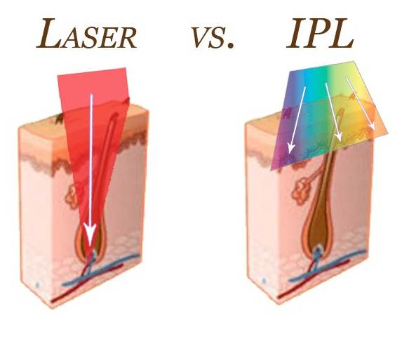 Laser Vs IPL