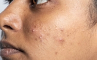 Acne-prone skin