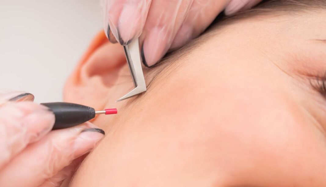 Can Electrolysis Lead to Permanent Scarring