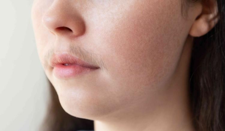 How Do I Stop My Hirsutism from Growing