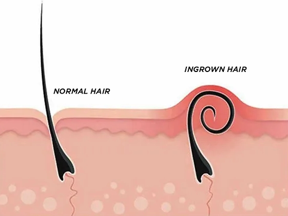 Lowered Risk of Ingrown Hair 