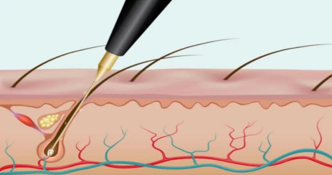 Electrolysis White Hair Removal