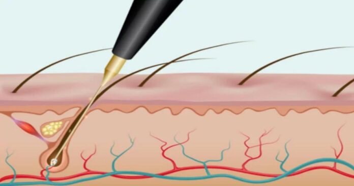 Electrolysis White Hair Removal: Cost, Side Effects and At-Home Devices Recommended