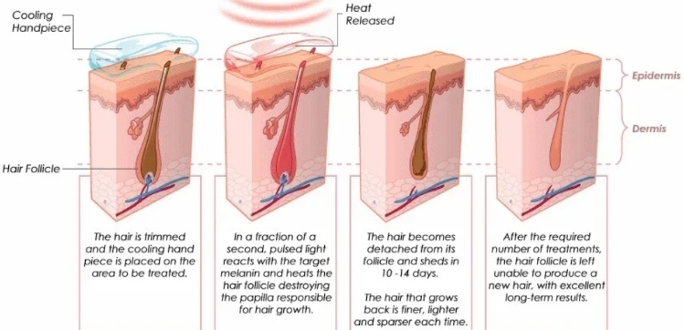 How Can I Set Up My Laser Hair Removal Schedule More Reasonably