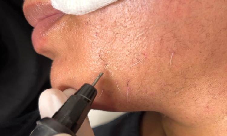 Is There Any Side Effect With Electrolysis White Hair Removal