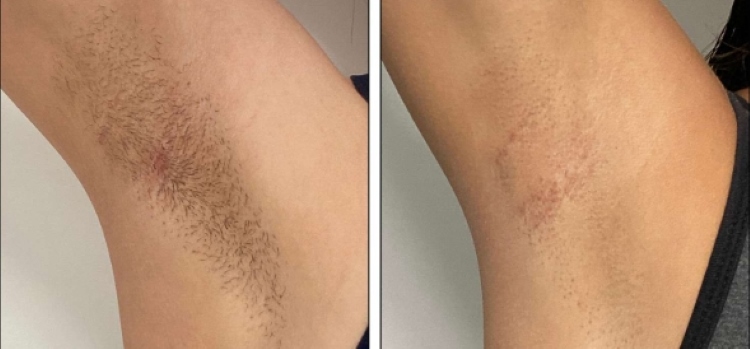 Which Frequency of At-Home Laser Hair Removal Sessions is Most Effective