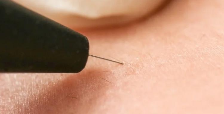 White Hair Removal at Home Electrolysis Devices