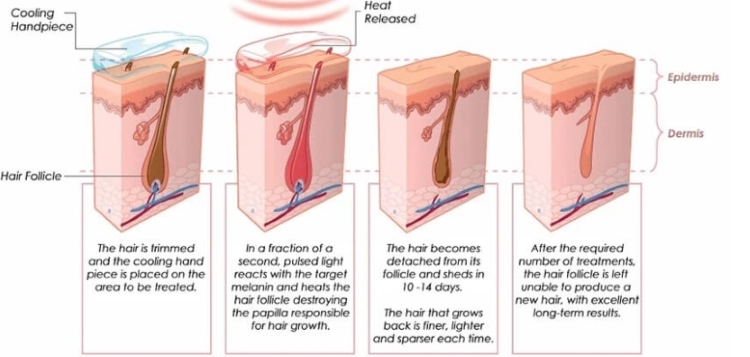 What Is At-Home Laser Hair Removal, and How Does It Work