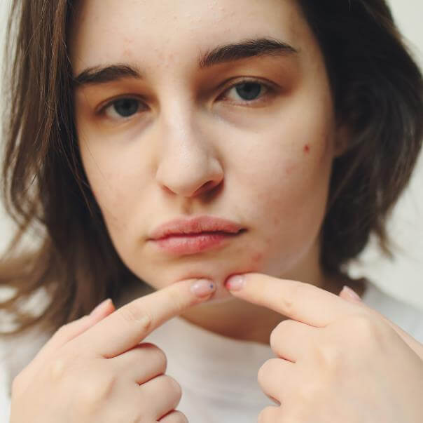 Acne Before Period Causes Types And How To Treatment