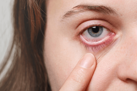 Eyelid Seborrheic Dermatitis
